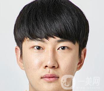 男人隆鼻前后附照片 隆鼻*果好嗎？