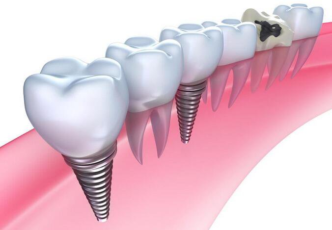 種植牙多少錢一顆 價格高不高？