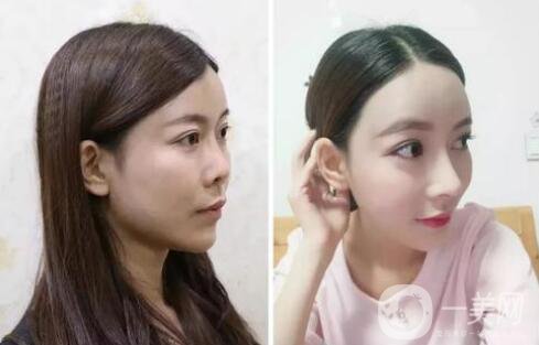 什么是朝天鼻？朝天鼻怎么矯正？