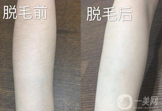 激光脫毛詳細(xì)介紹 激光脫毛有哪些優(yōu)缺點(diǎn)？