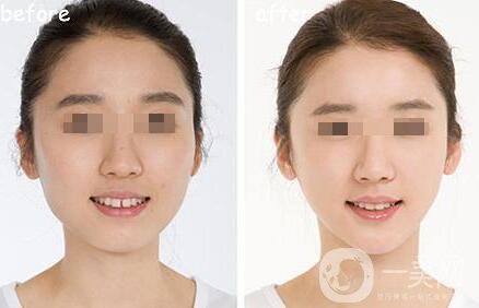 　　什么是短下巴手術?如果前下巴下陷，就用手術切下巴，把下巴向前移動。這種定制的手術使下巴向前移動，通過諸如前進、T截骨和假體插入等步驟，使面部線條自然而美觀，這取決于個人的下巴狀況。短下巴手術，以移動下巴尖向前，糾正不明確的下巴線，并改良你的臉，如果你的牙齒遮擋是好的，盡管你的下陷下巴。  什么是短下巴手術 短下巴手術類型  　　短下巴手術認為是一個短下巴(微頜)，如果下巴是下陷，牙合是差的。它可以通過雙頜截骨術(雙頜手術)矯正，使整個下巴向前移動。  　　雙頜截骨術(雙頜手術)的捷徑骨刀提高準確性，骨手術刀是一種超聲波裝置，它只對骨組織起反應作用，從而切割骨骼。它有較小的振動在0.5mm內，使一個**的手術，保護附近的血管和神經，只對骨骼作出反應，造成較少的組織損傷和出血，并提供*。    　　這些人需要做短下巴手術：  　　1、如果你的下顎凹陷了  　　2、如果你的下顎很小  　　3、如果你有突出的上牙  　　4、如果你的下巴和脖子有一個不清楚的界限  　　5、如果你看起來像下巴上有很多脂肪，下巴很短，就會有皺紋。  　　6、如果你經常聽到你看起來很遲鈍  　　短下巴手術類型  　　1、前下巴(下巴尖)前進。這個過程把下陷的骨頭切成向前移動的長度。根據骨切除的角度調整下巴的長度，形成一條自然的下頜線。  　　2、把下陷的骨頭往前移。這一過程減少和糾正了下巴的寬度，使下巴線條更苗條、更漂亮。  　　3、集骨。收集切割的骨頭并向前移動。  　　4、刮去骨頭。平滑地研磨下巴線。  　　5、假體插入。這個過程通過口腔的一個小切口將塑造成下巴骨輪廓的假體插入到下巴骨的前側。