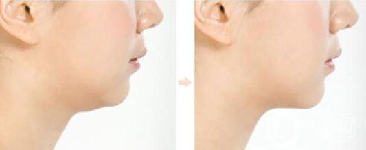 什么是短下巴手術 短下巴手術類型