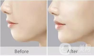 自體脂肪填下巴*果如何? 價格是多少呢？