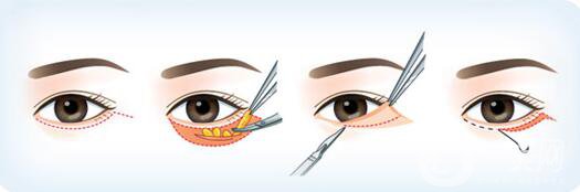 韓式去眼袋怎么樣？多久*果