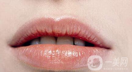 玻尿酸豐唇多久消腫,玻尿酸豐唇注意事項