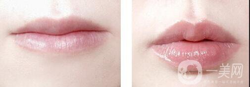 玻尿酸豐唇多久消腫,玻尿酸豐唇注意事項