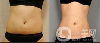 腰部吸脂價(jià)格