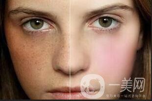 黃褐斑,老年斑,雀斑