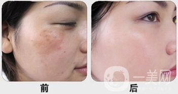 白瓷娃娃做完多久*果？幾次*果？