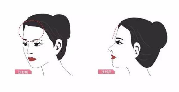 額頭自體脂肪保持多久 是*的嗎