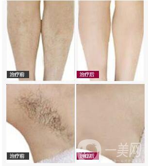 影響腋下脫毛價格的因素有哪些