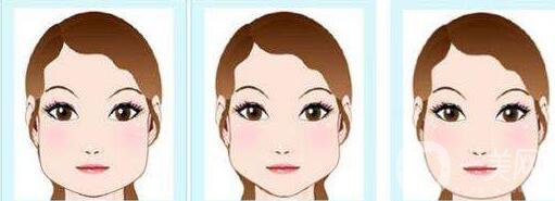 磨骨手術需要多少錢 調節(jié)費用是多少