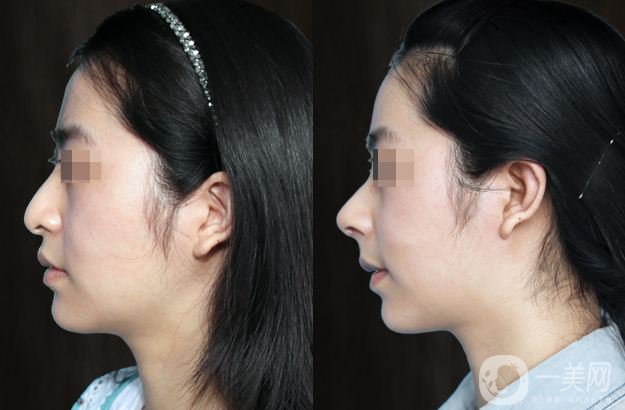 耳軟骨鼻尖多久會吸收 多久變自然呢？