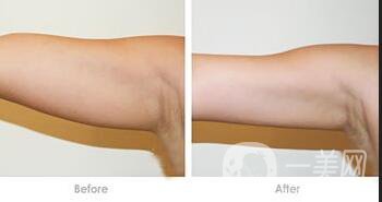 溶脂手術(shù)一般多少錢