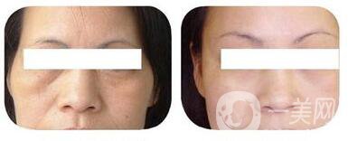 *除皺價(jià)格,*除皺費(fèi)用