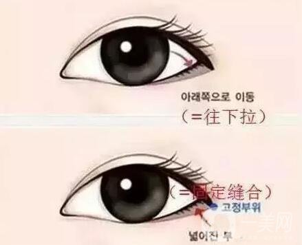 開內(nèi)外眼角的區(qū)別,開內(nèi)眼角,開外眼角