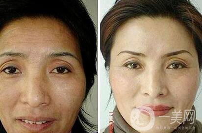 拉皮手術照片,拉皮手術后遺癥