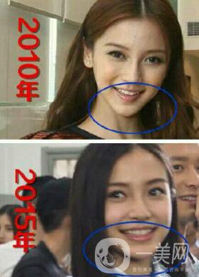 有沒有可能Angelababy不做整容手術(shù)就改變了這么多？