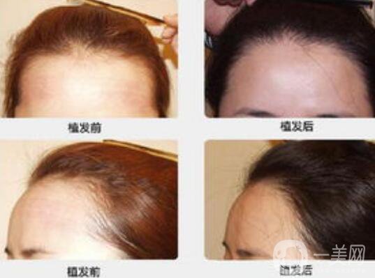 植發(fā)危害,植發(fā)優(yōu)點(diǎn),植發(fā)價(jià)格