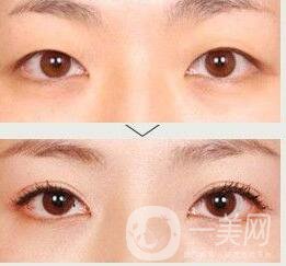 哪些人不適合做雙眼皮,雙眼皮價(jià)格,雙眼皮術(shù)后護(hù)理