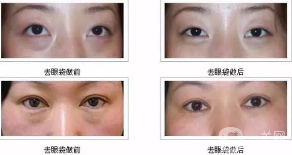 內(nèi)吸眼袋*果,去眼袋內(nèi)吸和內(nèi)切區(qū)別