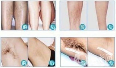 激光脫毛需要做幾次？*果真的*嗎？