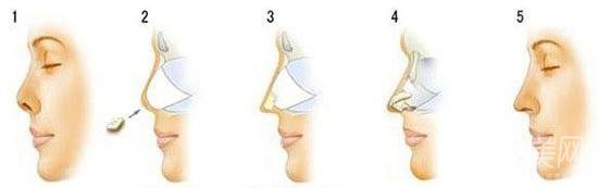 自體肋軟骨隆鼻后遺癥有些啥？