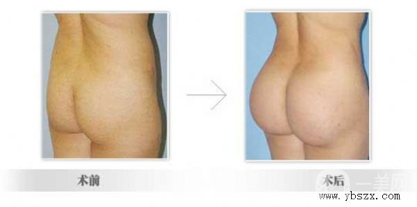 豐臀可以打玻尿酸嗎？*果如何？