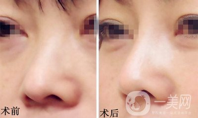 膨體隆鼻是終生的嗎？