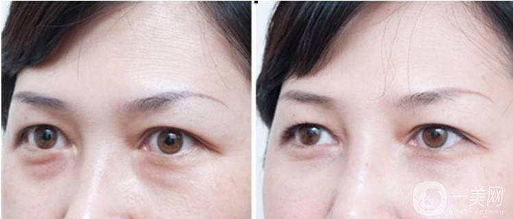 超聲波去眼袋多少錢 超聲波去眼袋價格