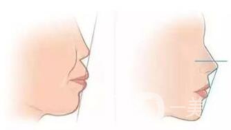 臉型矯正手術多少錢