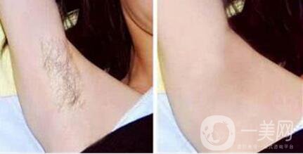 *激光脫毛多少錢,*激光脫腋毛費用