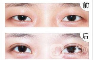 上眼皮吸脂價格,雙眼皮