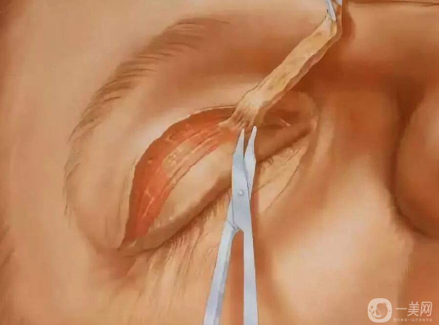 上眼皮吸脂價格,雙眼皮