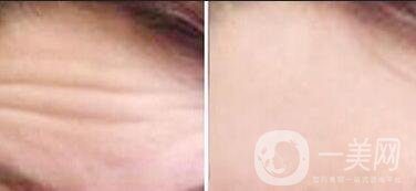 去除抬頭紋風(fēng)險(xiǎn),去除抬頭紋方法