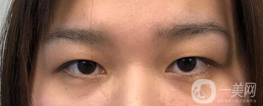 埋線雙眼皮維持幾年,納米*雙眼皮