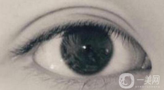 開(kāi)眼角疼嗎？這幾種情況開(kāi)眼角*果堪比換頭！