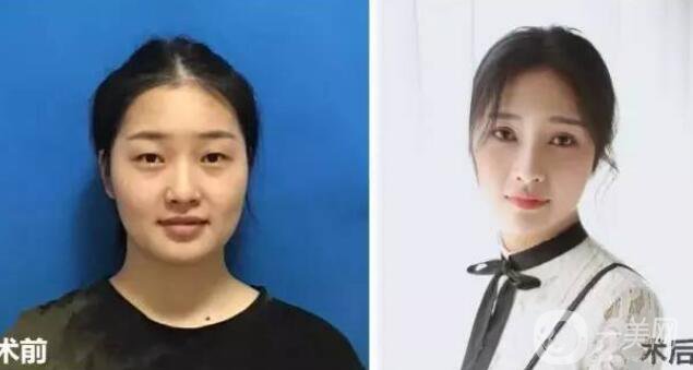 開(kāi)眼角疼嗎？這幾種情況開(kāi)眼角*果堪比換頭！