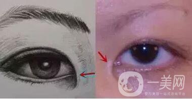 開(kāi)眼角疼嗎？這幾種情況開(kāi)眼角*果堪比換頭！