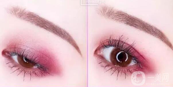 開(kāi)眼角疼嗎？這幾種情況開(kāi)眼角*果堪比換頭！