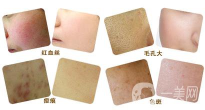 彩光嫩膚好嗎？*果如何？