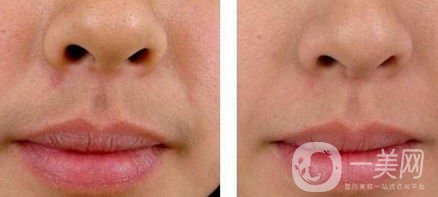 冰點脫唇毛靠譜嗎？