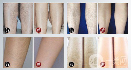 激光脫毛脫了還會長嗎？