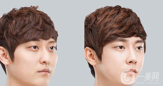 高級面部輪廓手術(shù)有哪些？