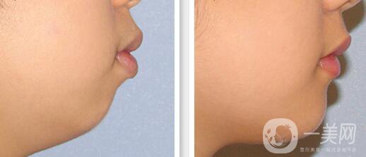 高級面部輪廓手術(shù)有哪些？