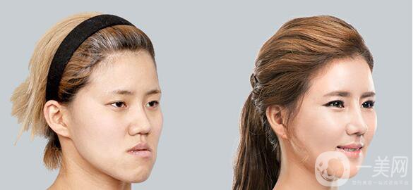 高級面部輪廓手術(shù)有哪些？