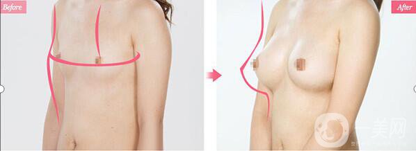 韓國假體隆胸手術