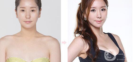 韓國假體隆胸手術