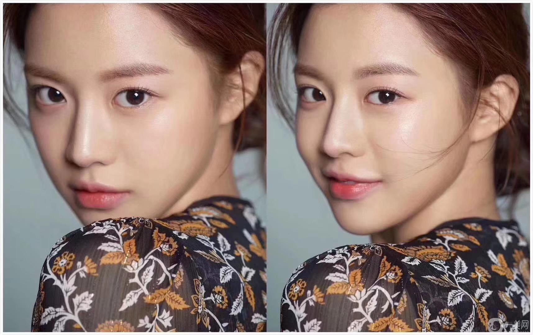 割完雙眼皮多久能化妝 如何護(hù)理能盡快恢復(fù)？