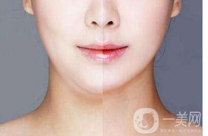 臉部吸脂術(shù)大概多少錢 臉部吸脂會反彈嗎？